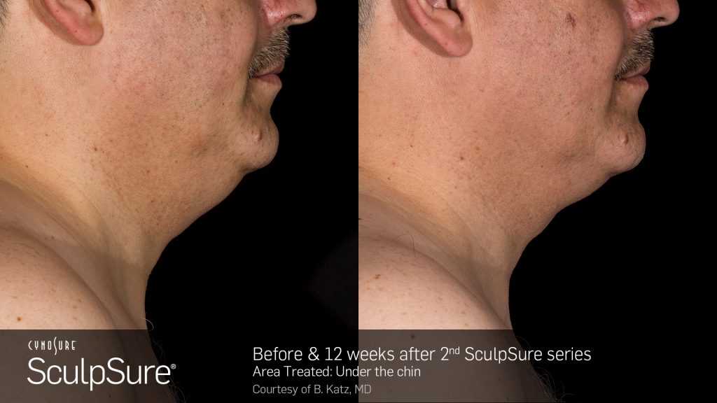 Before and after SculpSure submental results