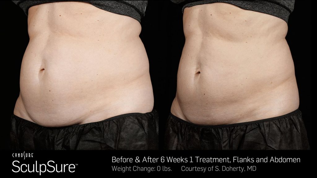 Before and after SculpSure results