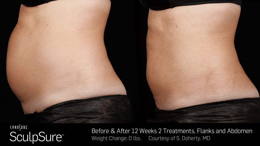 Before and after SculpSure results