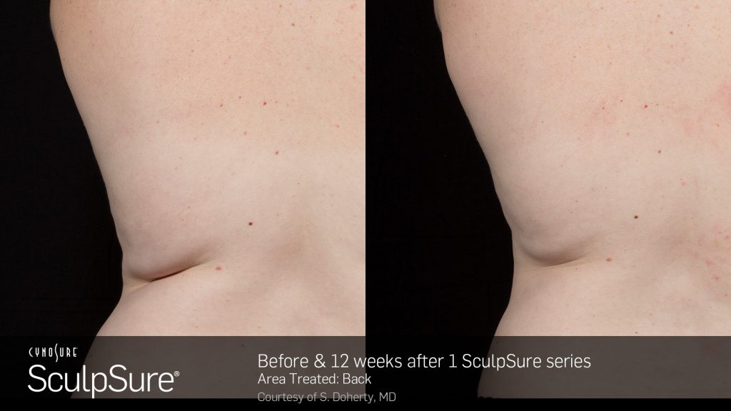 Before and after SculpSure results